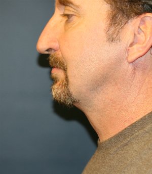 Chin Implant with Neck procedure - after - front