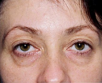 Blepharoplasty Case 21 - before - front
