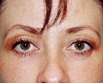 Blepharoplasty Case 21 - after - front