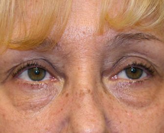 Blepharoplasty Case 22 - before - front