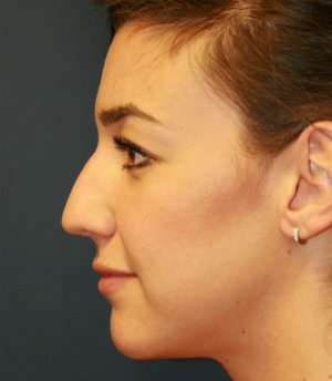 rhinoplasty san diego 52 - before - front