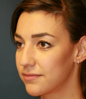 rhinoplasty san diego 52 - before - oblique