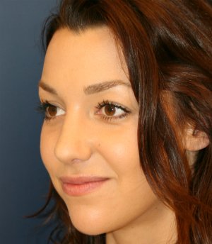 rhinoplasty san diego 52 - after - oblique
