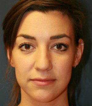 rhinoplasty san diego 52 - before - side