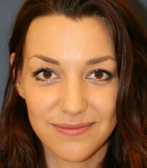 rhinoplasty san diego 52 - after - side