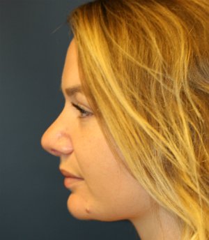 rhinoplasty san diego 53 - after - front