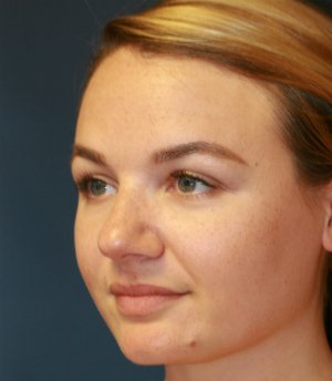 rhinoplasty san diego 53 - before - oblique