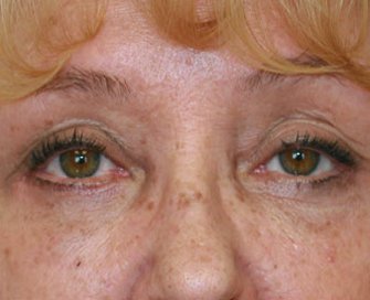 Blepharoplasty Case 22 - after - front