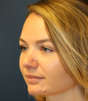 rhinoplasty san diego 53 - after - oblique