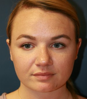 rhinoplasty san diego 53 - before - side