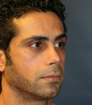 rhinoplasty san diego 54 - after - front