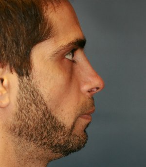 rhinoplasty san diego 54 - before - oblique