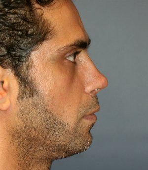 rhinoplasty san diego 54 - after - oblique