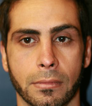 rhinoplasty san diego 54 - before - side