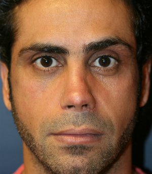 rhinoplasty san diego 54 - after - side