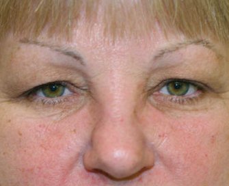 Blepharoplasty Case 24 - before - front