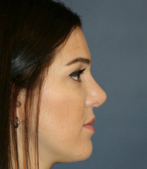 rhinoplasty san diego 55 - after - front