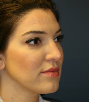 rhinoplasty san diego 55 - before - oblique
