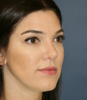 rhinoplasty san diego 55 - after - oblique