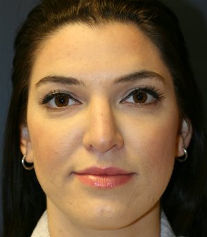 rhinoplasty san diego 55 - before - side