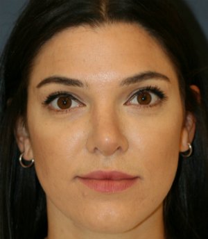 rhinoplasty san diego 55 - after - side
