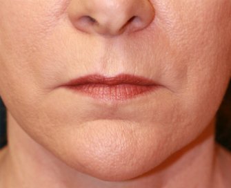 Corner of Lip Lift 138 - before - front