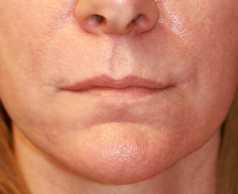 Corner of Lip Lift 138 - after - front