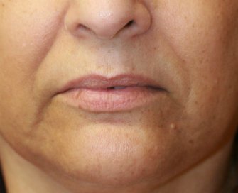 Corner of Lip Lift 139 - before - front