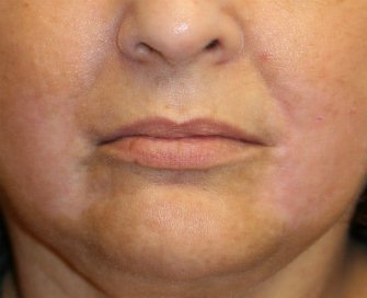 Corner of Lip Lift 139 - after - front