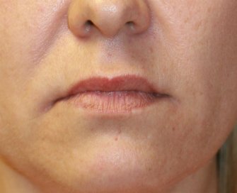 Corner of Lip Lift 140 - before - front