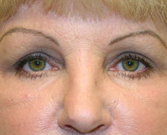 Blepharoplasty Case 24 - after - front