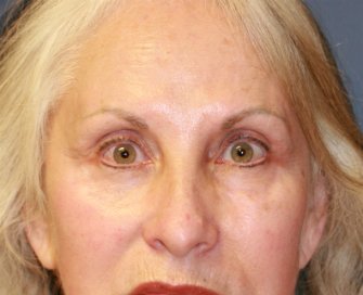 Removing grafted eyelid fat - before - front