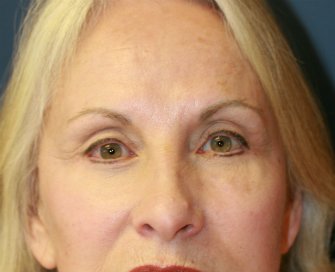 Removing grafted eyelid fat - after - front