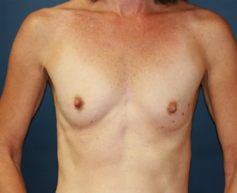Breast Implants after five years - before - front
