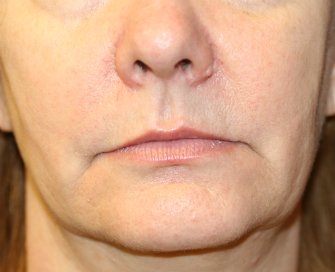 Lip Lift, Corner Lift, Jowl Removal - before - front