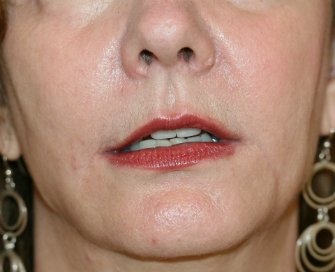 Lip Lift, Corner Lift, Jowl Removal - after - front