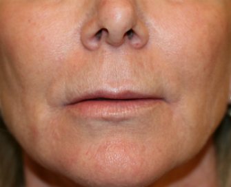 upper lip lift 145 - before - front