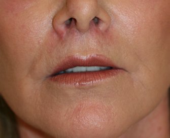 upper lip lift 145 - after - front