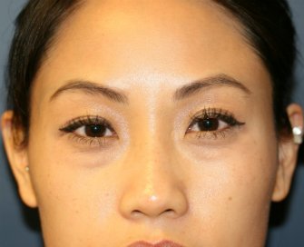 Lower eyelid bulges removal - before - front