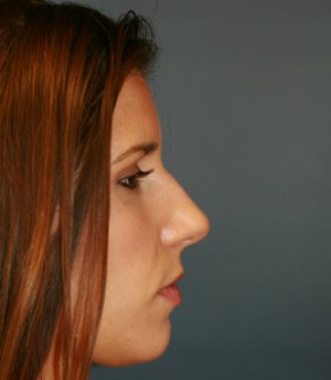 Rhinoplasty San Diego 56 - before - front