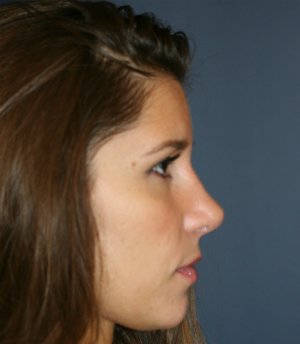 Rhinoplasty San Diego 56 - after - front