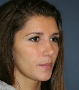 Rhinoplasty San Diego 56 - after - oblique