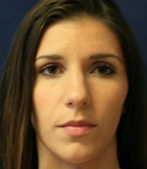 Rhinoplasty San Diego 56 - before - side