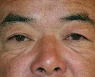 Blepharoplasty Case 25 - before - front