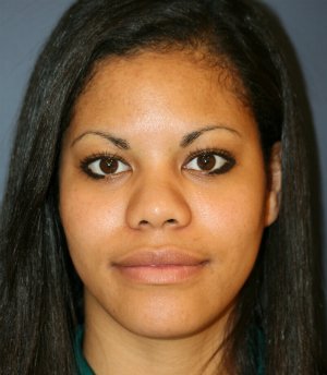 Rhinoplasty San Diego 57 - before - front