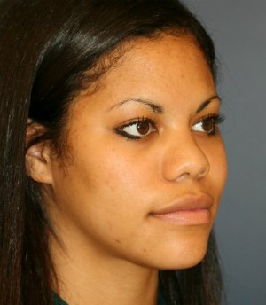 Rhinoplasty San Diego 57 - before - oblique