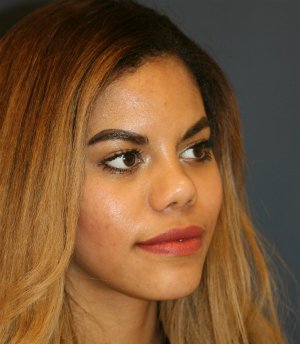 Rhinoplasty San Diego 57 - after - oblique