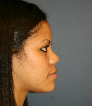 Rhinoplasty San Diego 57 - before - side