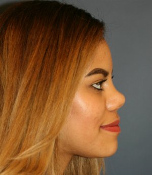 Rhinoplasty San Diego 57 - after - side