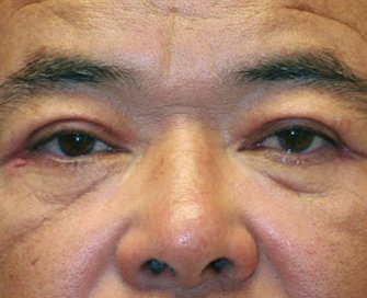 Blepharoplasty Case 25 - after - front